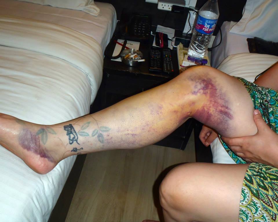 Further progress on the leg — still upright, still on enough alcohol to manage